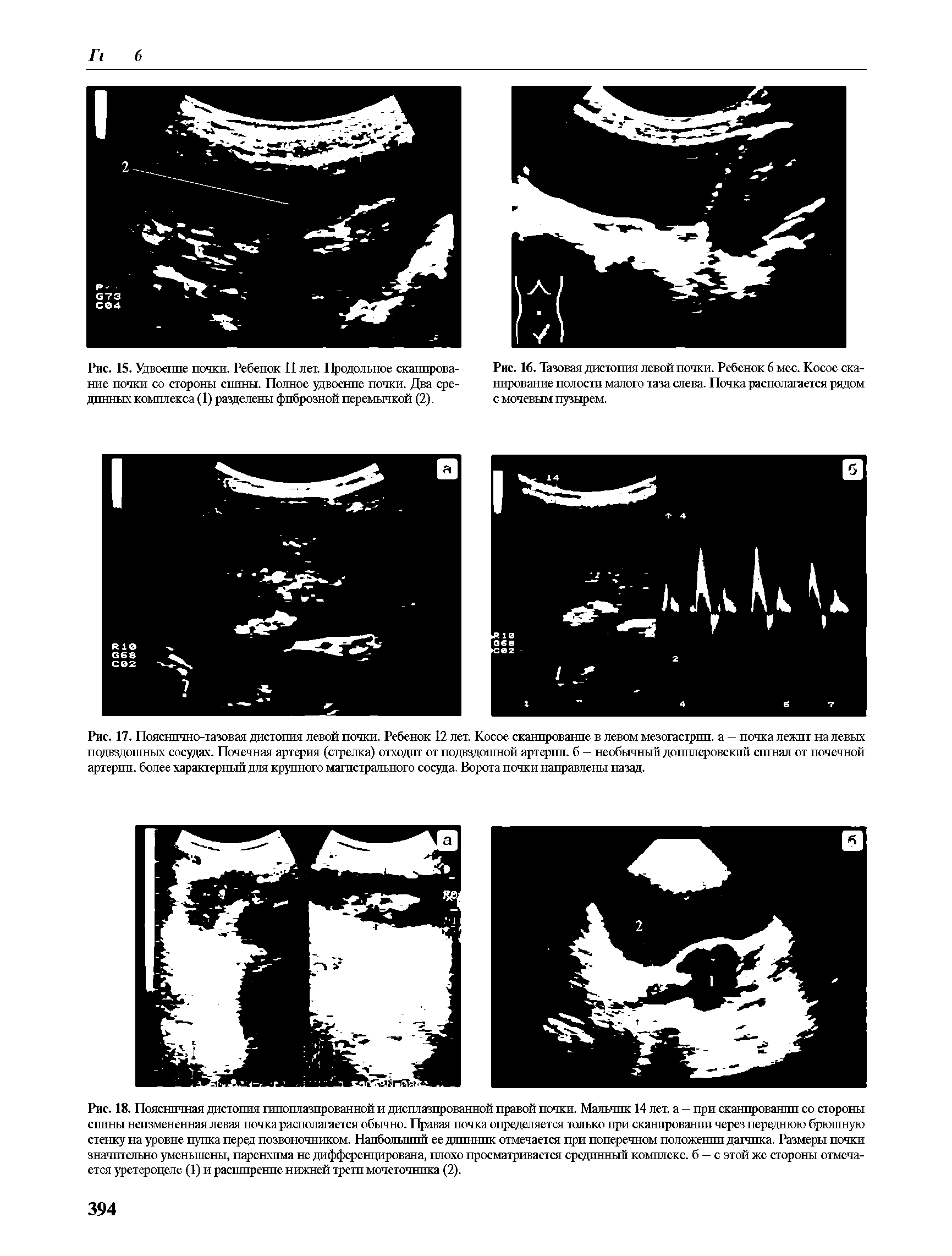 Рис. 16. Тазовая дистопия левой почки. Ребенок 6 мес. Косое сканирование полости малого таза слева. Почка располагается рядом с мочевым пузырем.
