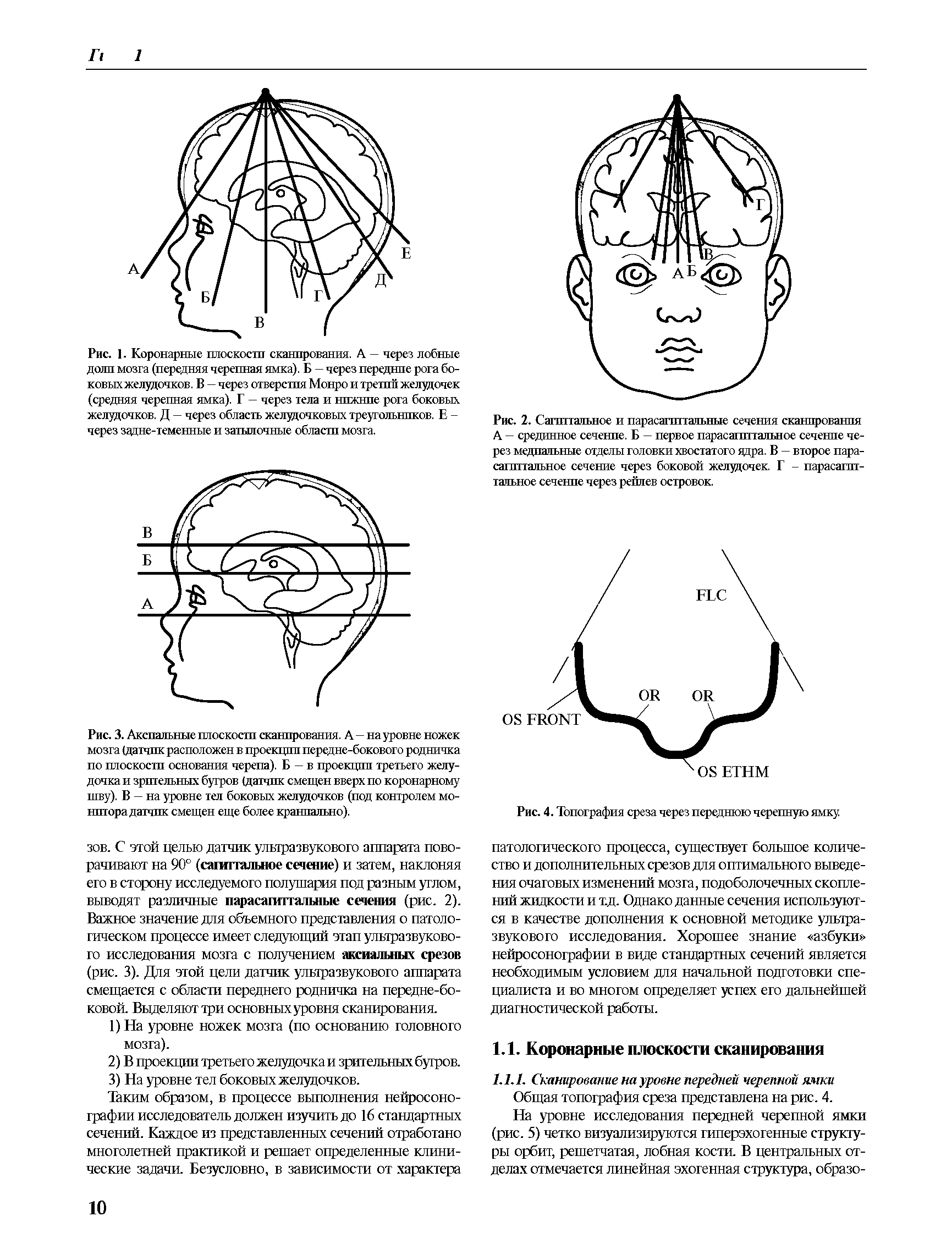 Рис. 1. Коронарные шоскосш сканпрования. А - через лобные доли мозга (передняя черепная ямка). Б — через передние рога боковых желудочков. В — через отверстия Монро и трешп желздочек (средняя черепная ямка). Г — через тела и нижние рога боковых желудочков. Д — через область желудочковых треугольников. Е -через задне-теменные и затылочные области мозга.
